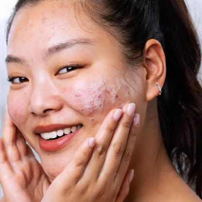 SVR - Rutina Anti-Acné